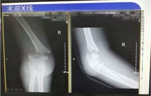 肱骨髁上骨折闭合复位手术记录,小儿肱骨髁上骨折手术恢复的概率