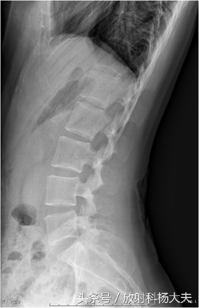 花季少女腰疼是什么原因,青春期女生为什么总是腿痛