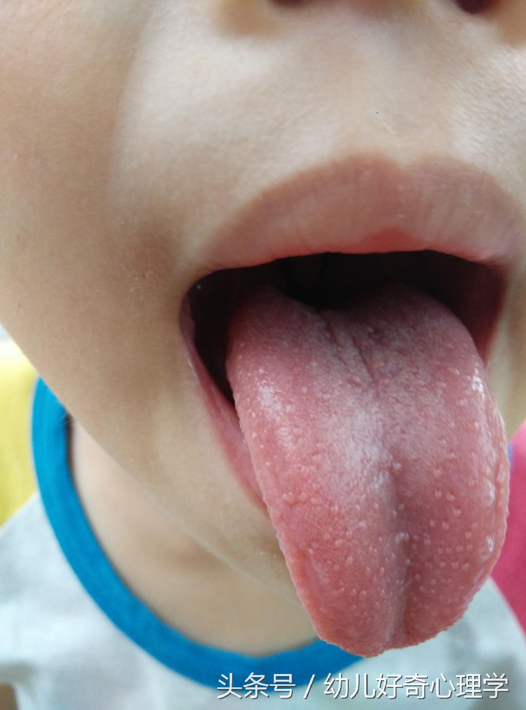 婴幼儿舌头发黑是怎么回事,婴幼儿舌头发紫的图片