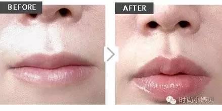 玻尿酸丰唇心得,丰唇失败了如何化妆拯救