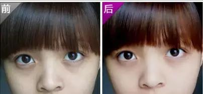 黑眼圈很重又必须熬夜怎么办,熬夜上夜班黑眼圈加重怎么消除