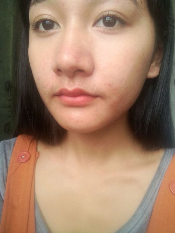 拯救爆痘肌肤,刷酸爆痘脱皮需要怎么办呢