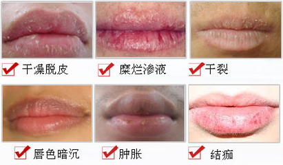 嘴唇裂口脱皮吃什么药,常年嘴唇开裂脱皮是怎么回事