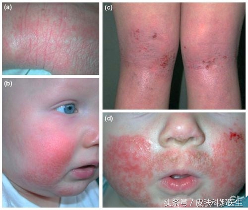 孩子反复湿疹皮炎怎么回事,婴儿长期湿疹会变成特应性皮炎吗