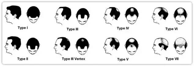 光头脱发治疗最快的方法,生姜治脱发需要剃光头吗