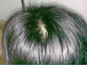 掉头发严重如何生发,掉头发很厉害怎样能够生发