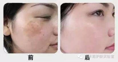 怎样才能避免得激素脸,激素脸的正确修复小窍门