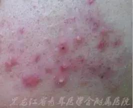 皮肤病的饮食注意哪些,常见皮肤病食疗