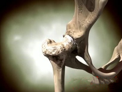 二期股骨头坏死怎样算保髋告捷,股骨头坏死有哪些保髋治疗方法