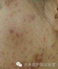 揭秘快速美白祛斑套路,祛斑美白技术视频