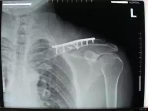 小孩锁骨骨折最好的治疗方法,锁骨远端骨折手术多久能恢复正常