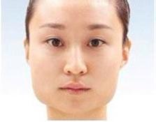 下颌角决定自己的颜值,下颌线决定颜值