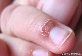 宝宝手指倒刺脱皮,手指脱皮长倒刺怎么回事