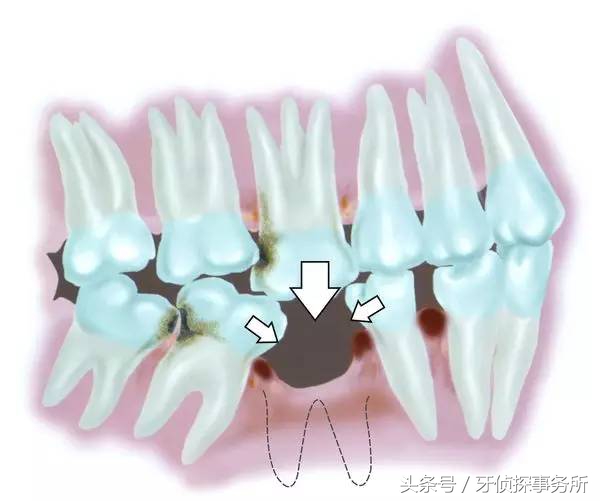 吃肉就塞牙怎么彻底解决,吃肉塞牙有什么好的办法解决