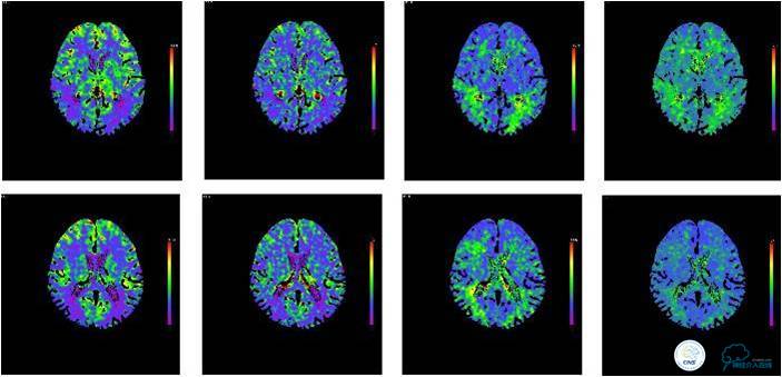 右侧大脑中动脉区可见两支血管,什么是左侧大脑中动脉代偿供血