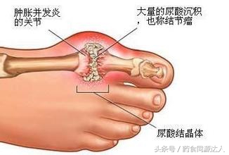 痛风中医辨证论治经方,中医治痛风辨证四法