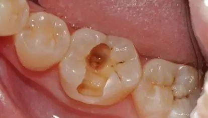 蛀牙怎样才能控制住不再有蛀牙,蛀牙不严重用什么药