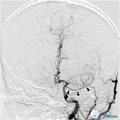 右侧大脑中动脉区可见两支血管,什么是左侧大脑中动脉代偿供血