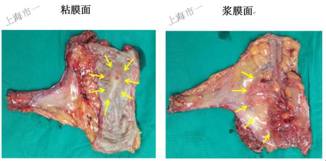 直肠有哪几种情况需要手术,直肠病变esd手术指南