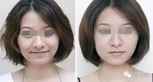 爱笑的女孩只有法令纹,果然爱笑的女孩法令纹很重了