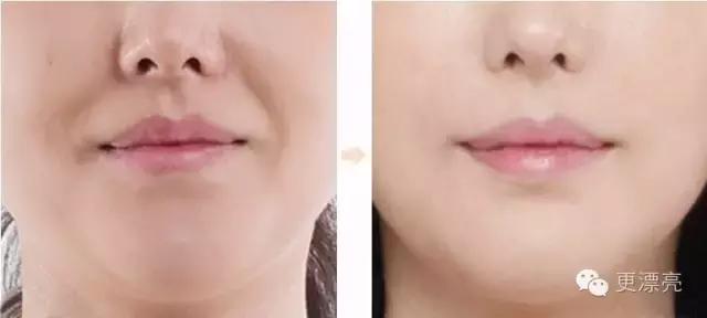 爱笑的女孩只有法令纹,果然爱笑的女孩法令纹很重了