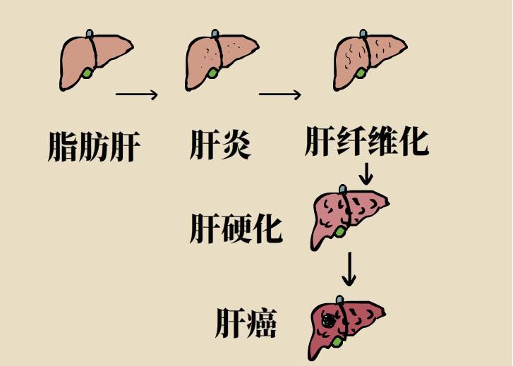 脂肪肝是如何进化成肝癌的,科普脂肪肝也能发展成为肝癌