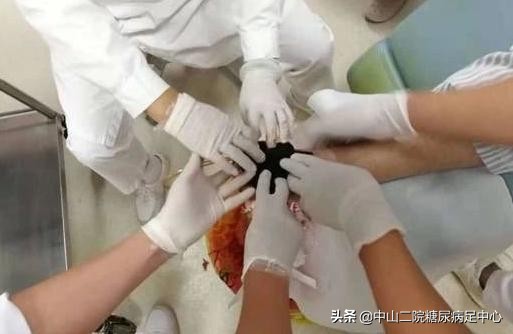 糖尿病足清创最佳治疗方法,糖尿病足怎么清创消毒