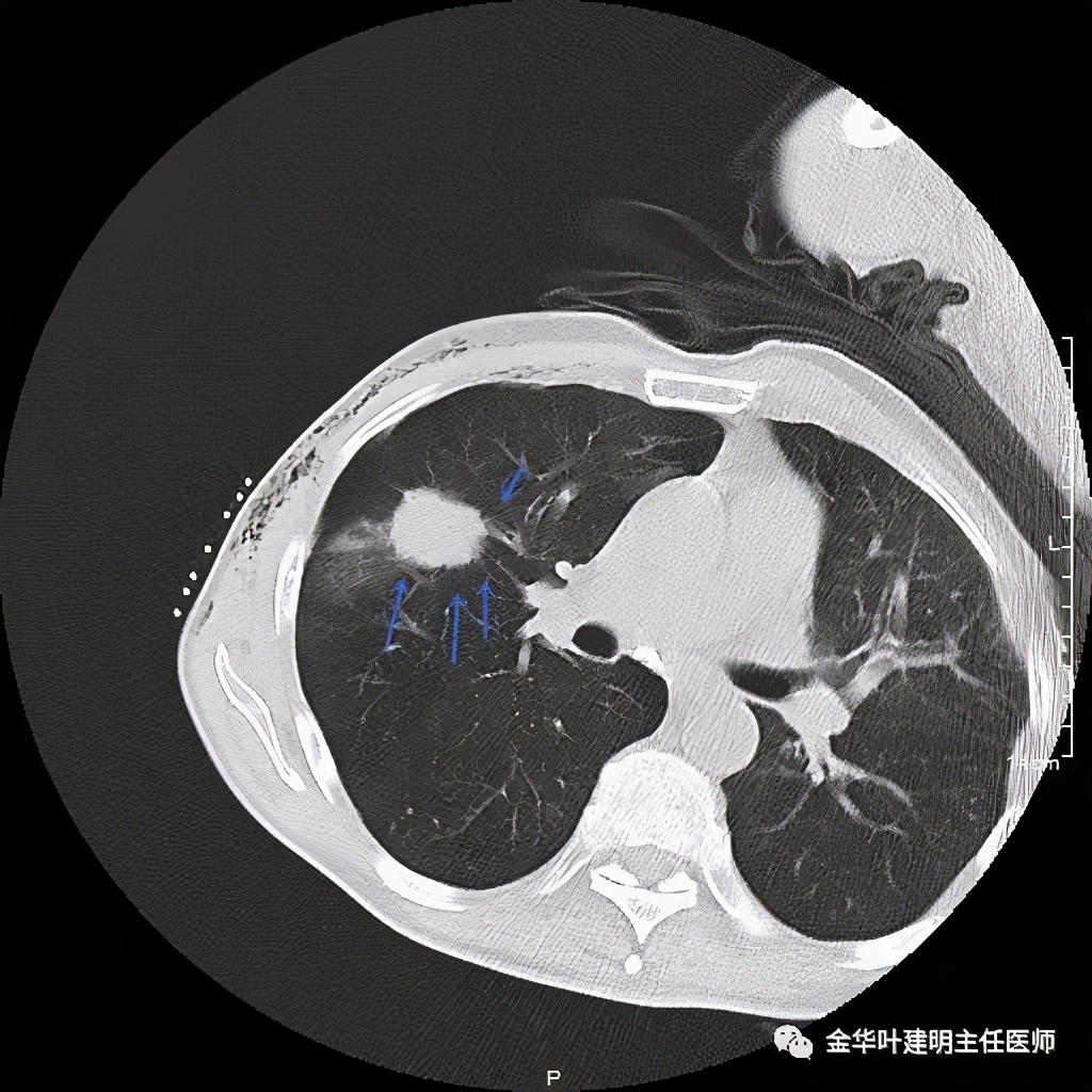 左肺占位被安排穿刺活检是肺癌吗,肺癌肺部穿刺有什么危险