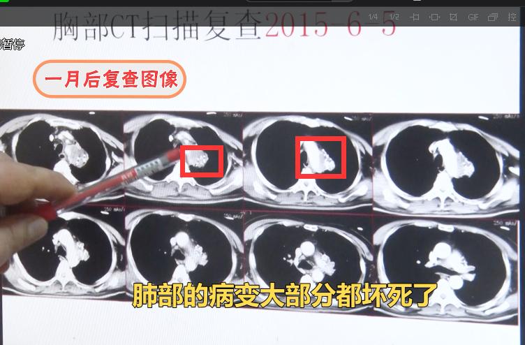 肺癌转移到脑癌死前3个月症状,48岁女子肺癌晚期死亡
