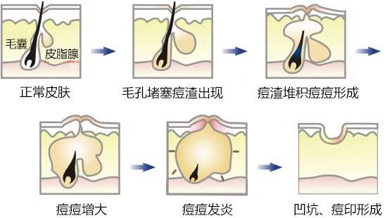 痘印痘坑怎么修复淡化痘印推荐,痘印痘坑真正祛除的方法