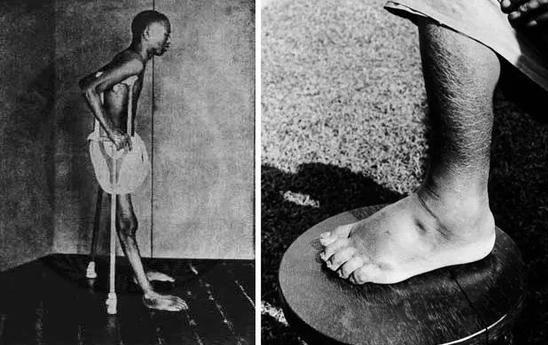 区区一个脚气病，差点灭掉日本*队军**，还改变了日本的国运……