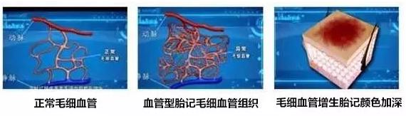 治疗鲜红斑痣都有什么方法,治疗鲜红斑痣怎么缓解害怕