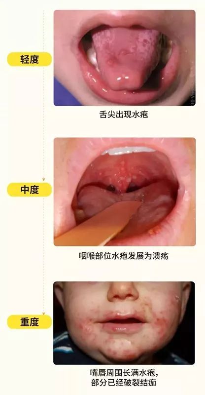 多地流感病人爆发如何预防,如何预防下一场流行病的爆发
