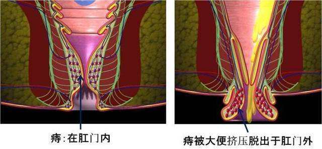 痔疮出血不治疗有什么并发症吗,痔疮没有治好有哪些并发症