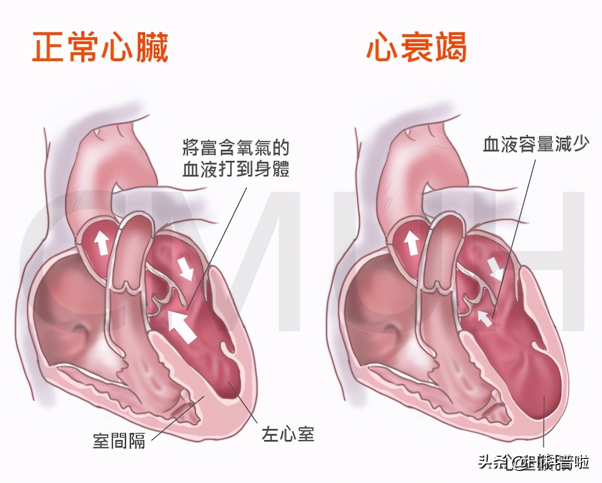 第四代磁悬浮人工心脏人民日报,中国告捷研制出磁悬浮心脏了吗