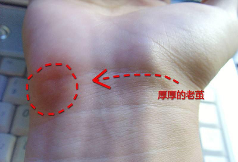 经常手痛的原因是什么,手又酸又痛是什么原因