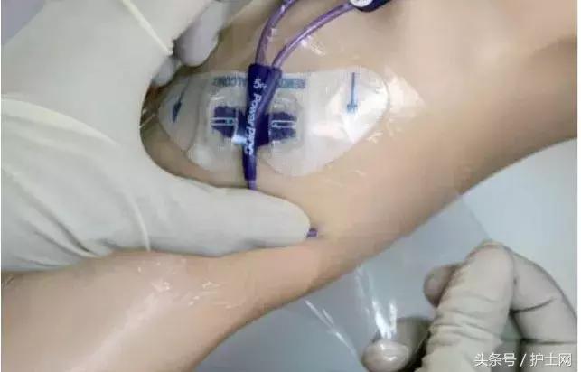 picc置管术在颈部吗,颈部picc管是怎么放进去的