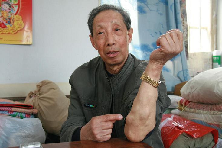 身上有小肉疙瘩会癌变吗,身上长了很多小肉粒是癌症吗