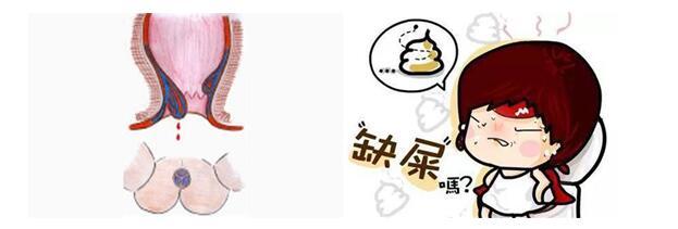 怎么能够避免怀孕得痔疮,怀孕女性的外痔疮怎么治疗