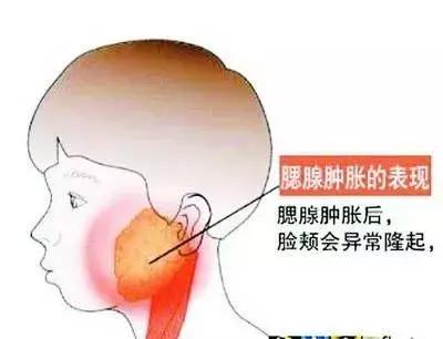 三明家长们请注意！5月小心“大脸病”，儿童最易遭受侵袭！