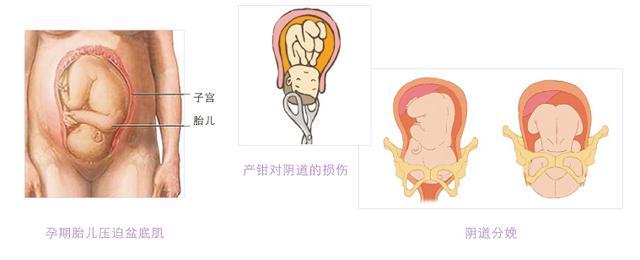 女性盆底健康的意义,盆底肌对女性有什么功能