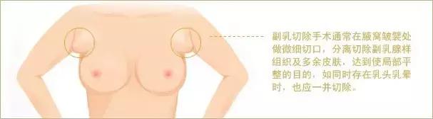 腋下难看的那两坨肉，能够转变为乳房吗？