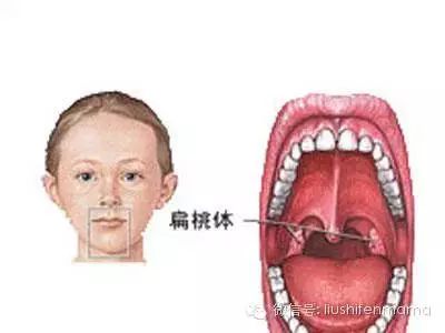 扁桃体炎引起的高烧不退咽喉脓肿，只能靠吃药吗？！