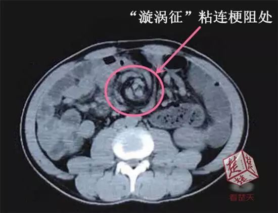 男子意外发现巨型漩涡,男子肚子里出现16厘米酒瓶