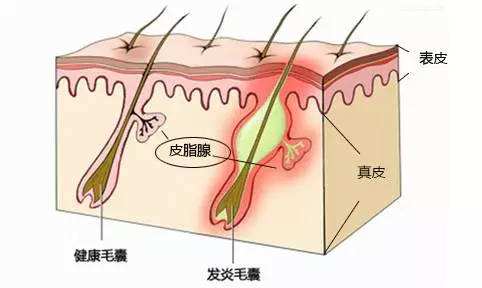下巴长的白色小颗粒怎么去除,下巴长了很多小颗粒是不是闭口