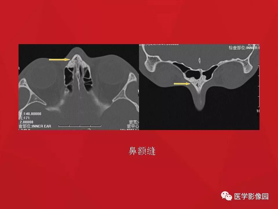 左侧鼻骨骨折伴鼻中隔骨折,双侧鼻骨及左上颌骨突骨折