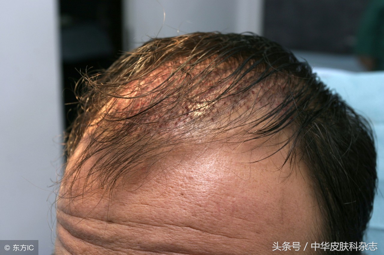 毛发毛囊移植需要什么设备,毛发毛囊移植案例