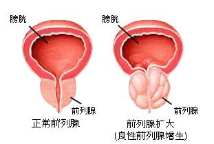 前列腺增生中医病因病机,西地那非治疗前列腺增生怎么用药