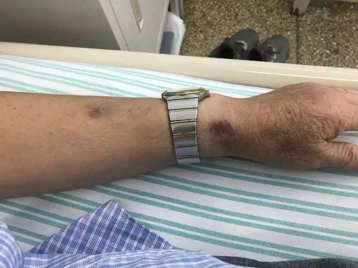 皮炎平软膏导致黑色素冷静,大伯吃掉上百支皮炎平软膏