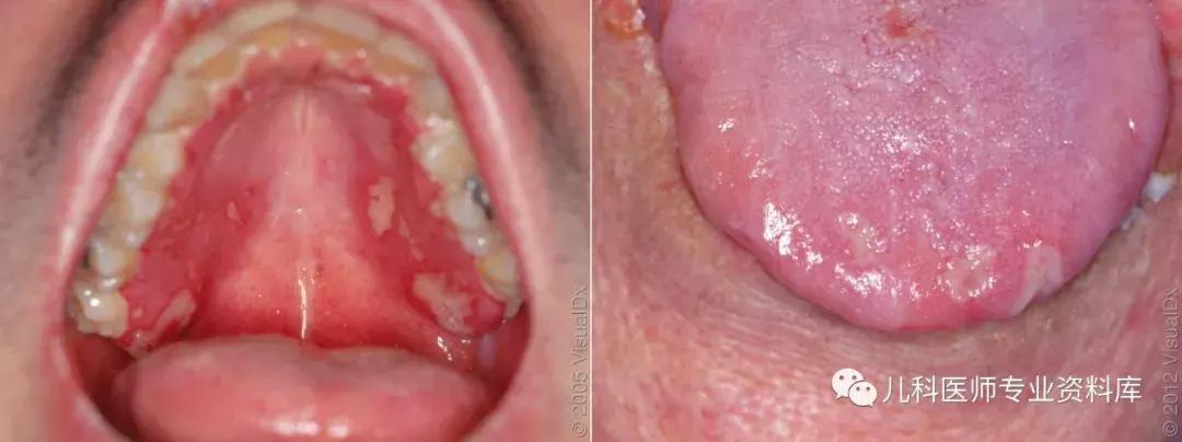 宝宝嘴巴上火的症状,宝宝嘴巴臭是积食还是上火